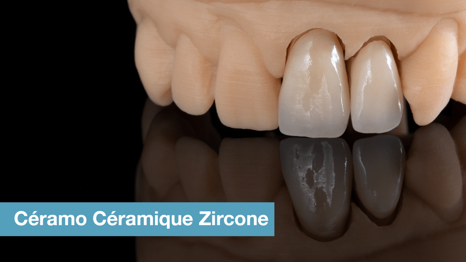 Couronne Ceramo Ceramique Zircone Laboratoire De Proth Ses Dentaires Crown Ceram