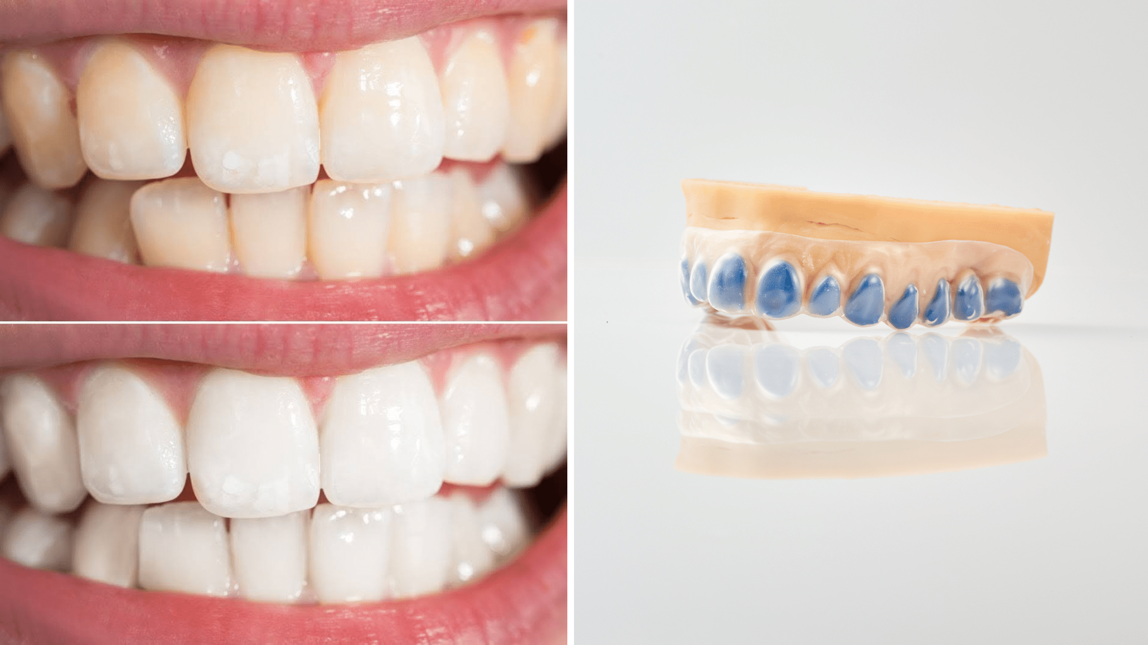 Éclaircissement Dentaire En Ambulatoire Ou Au Fauteuil ?